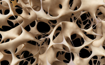 Osteoporosis: una enfermedad silenciosa