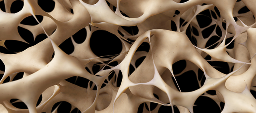 Osteoporosis: una enfermedad silenciosa